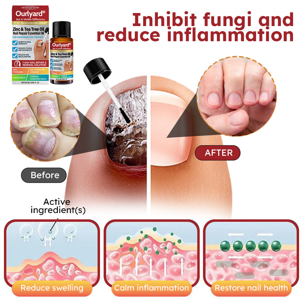 ✅ Made and Shipped from USA | Ourlyard® Zinc & Tea Tree Oil Nail Repair Essential Oil (Comprehensive repair, powerful treatment for all nail disorders) 🍀🍀