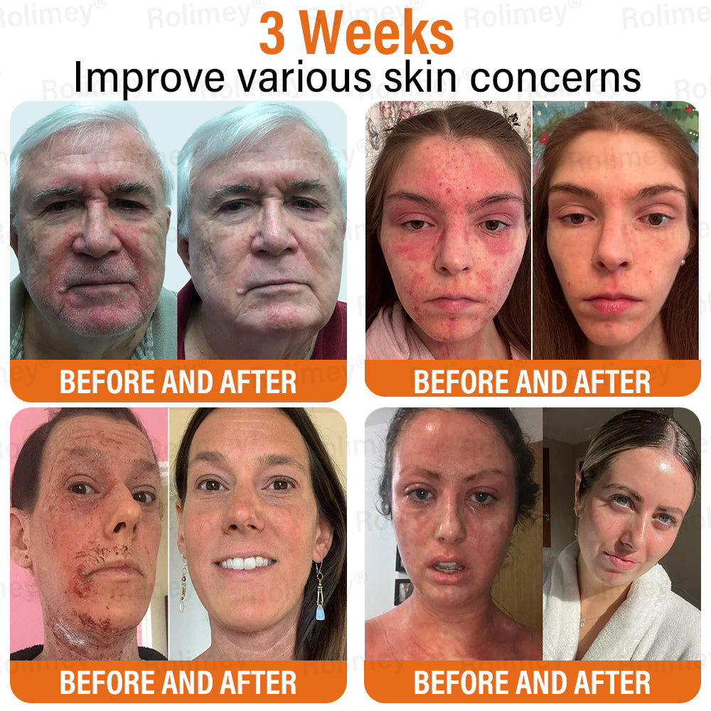 ✅Official Store | ✨ Rolimey® Bee Venom Golden Liposome Capsule Repair Cream 🧑🏼⚕️(For skin prone to tinea, psoriasis, warts, hidradenitis, and varicose concerns)