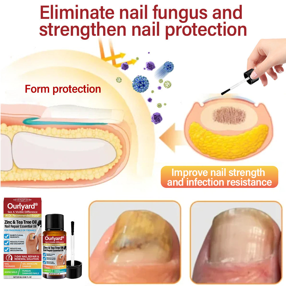 ✅ Made and Shipped from USA | Ourlyard® Zinc & Tea Tree Oil Nail Repair Essential Oil (Comprehensive repair, powerful treatment for all nail disorders) 🍀🍀