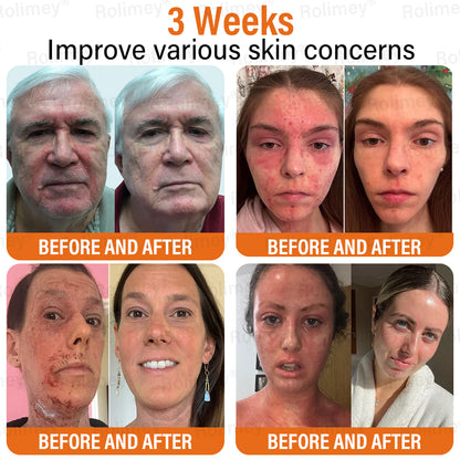 ✅Official Store | ✨ Rolimey®  Bee Venom Golden Liposome Capsule Repair Cream  🧑🏼‍⚕️(For skin prone to tinea, psoriasis, warts, hidradenitis, and varicose concerns)